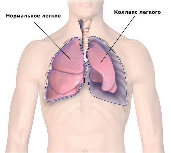 Российская молодежь массово страдает от схлопывания лёгких и гипоксии из-за вейпов — за год количество таких